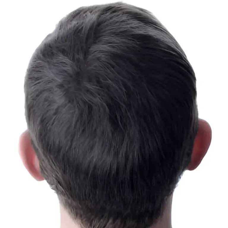 Back View of Scalp Highlighting Hair Restoration Progress – Before and After Gallery image