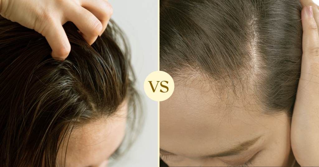 Stem Cell Hair Restoration vs. Hair Transplants: A Comprehensive Guide for Women