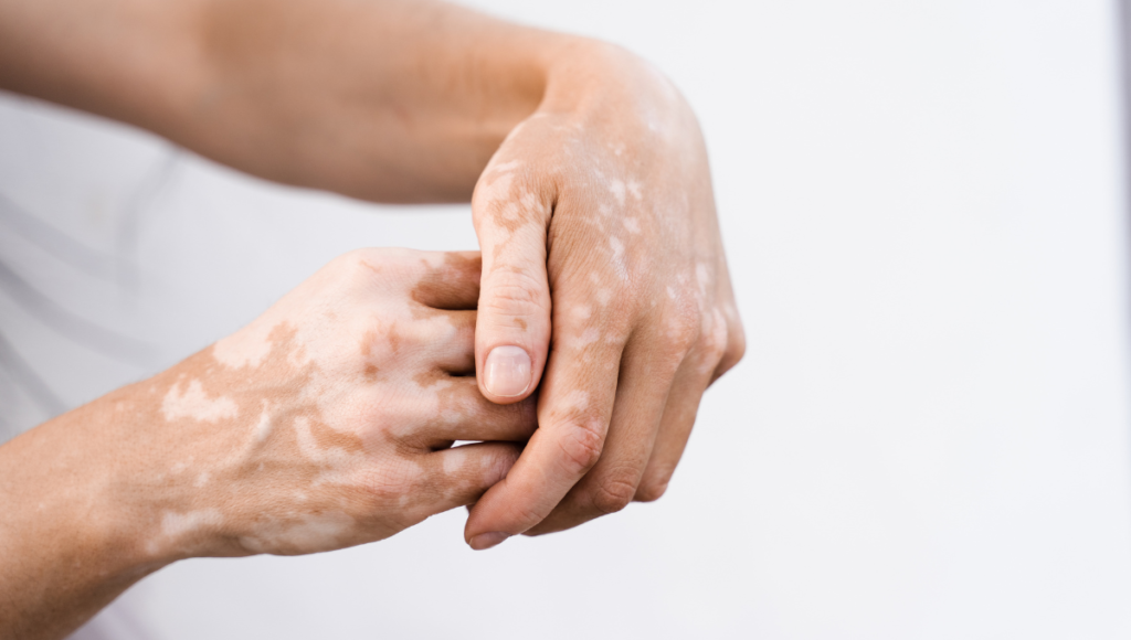 Stem Cell Therapy for Vitiligo: Restoring Radiance, Confidence, and Skin Tone—Naturally