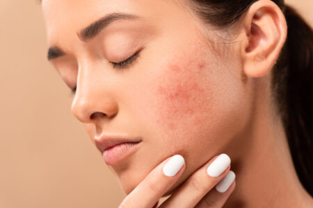 Healing Acne and Scars with Stem Cell Therapy