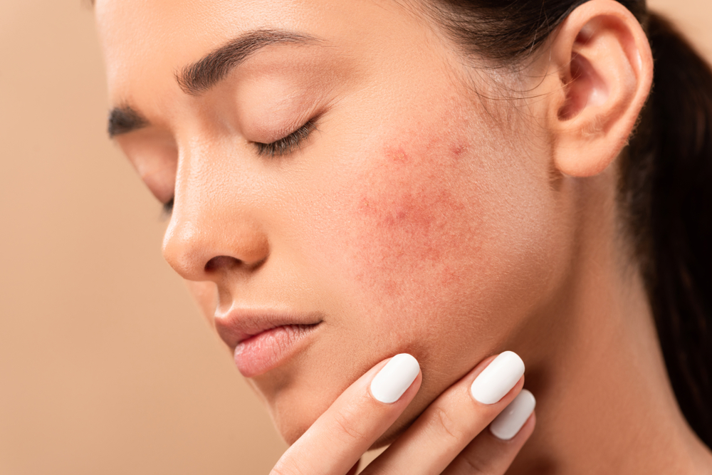 Healing Acne and Scars with Stem Cell Therapy