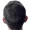 Back View of Scalp Highlighting Hair Restoration Progress – Before and After Gallery image