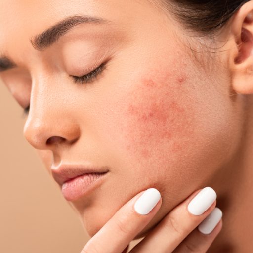 Healing Acne and Scars with Stem Cell Therapy