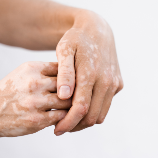 Stem Cell Therapy for Vitiligo: Restoring Radiance, Confidence, and Skin Tone—Naturally